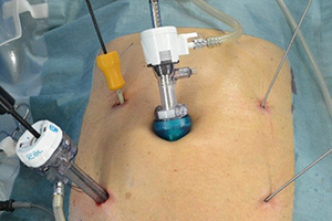 腹腔鏡下大腸切除術の手術適応