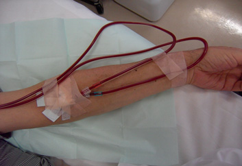 血液透析の特徴3