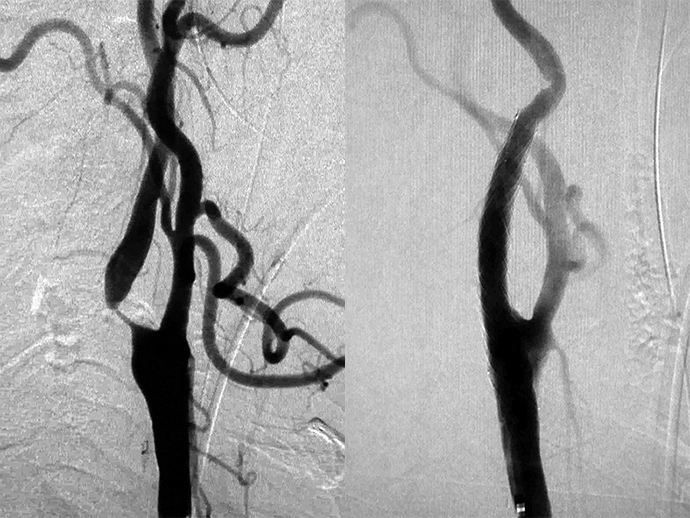 CTスキャンでクローン病がわかりますか?