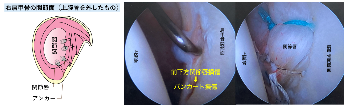 反復性肩関節脱臼04