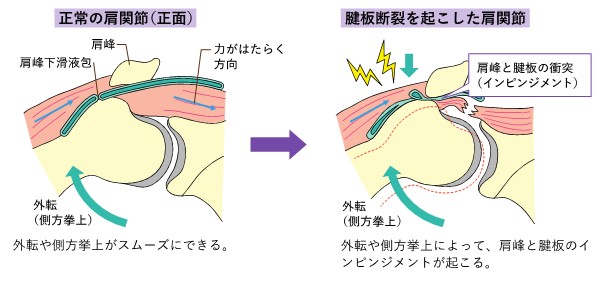 腱板断裂02