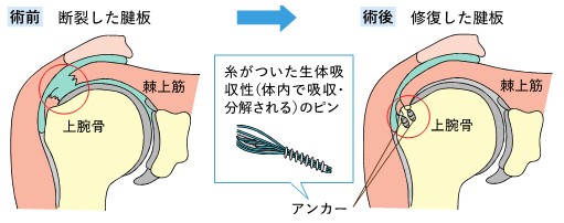 腱板断裂04