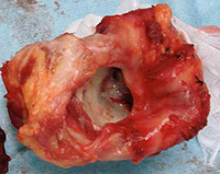 骨軟部組織の悪性腫瘍04