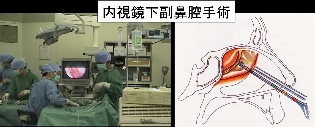 内視鏡下鼻内副鼻腔手術　耳鼻科　ESS森山寛春名眞一鴻信義