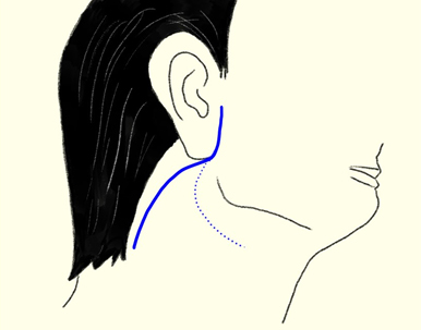 耳下腺腫瘍の手術02