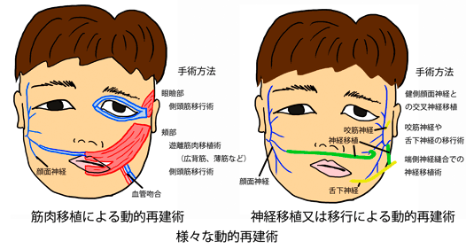ベル麻痺は目にどのような影響を及ぼしますか?