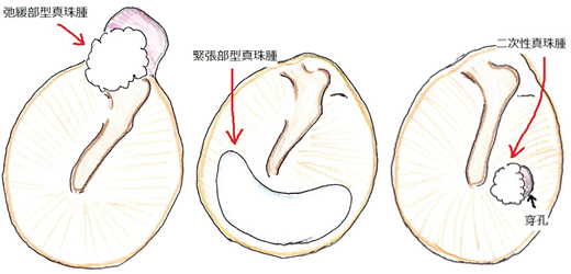 真珠腫の潜在的な合併症にはどのようなものがありますか?