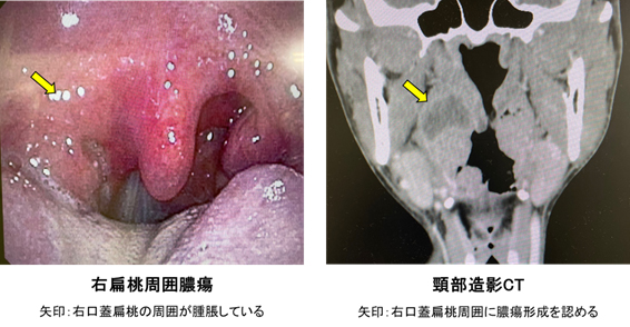 扁桃周囲膿瘍、扁桃周囲炎
