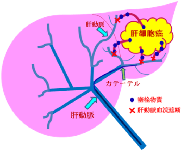 肝腫瘍01