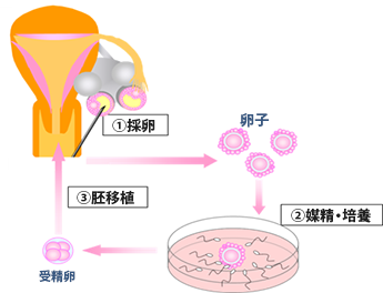 図5.体外受精（IVF）