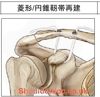 肩鎖関節脱臼07