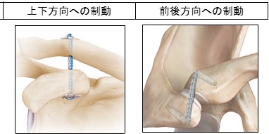 肩鎖関節脱臼06