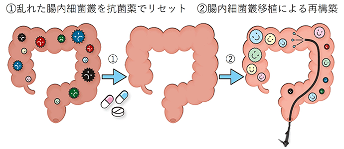 抗菌薬併用腸内細菌叢移植療法