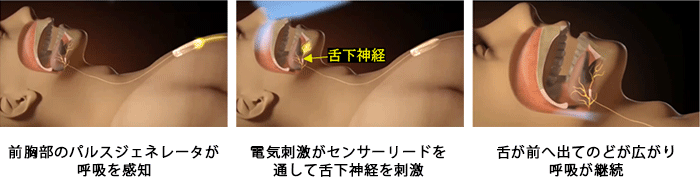 新聞稿]東京首個尖端睡眠呼吸中止症治療方法「舌下神經電刺激療法